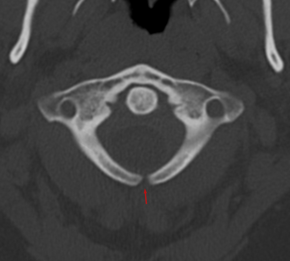 spina bifida