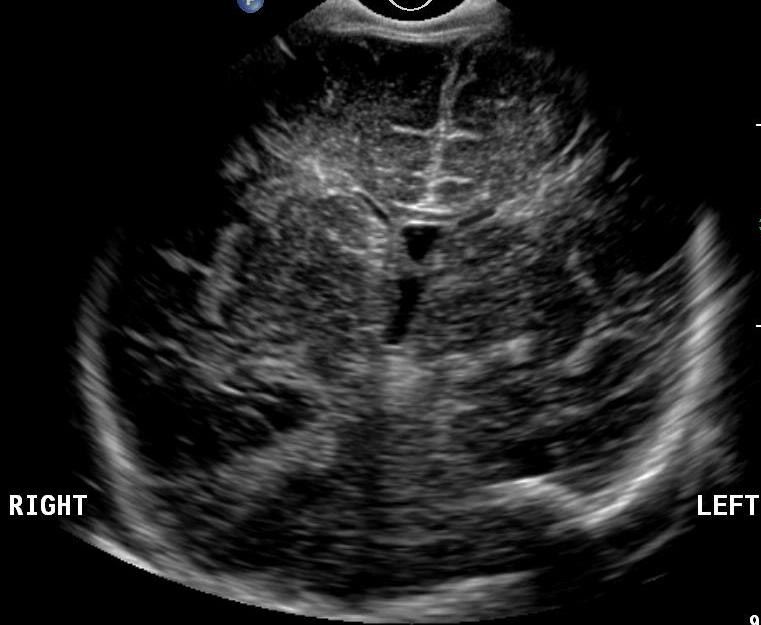 normal neonatal head ultrasound