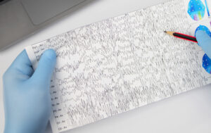 A neurologist examines an encephalogram of a patient’s brain.